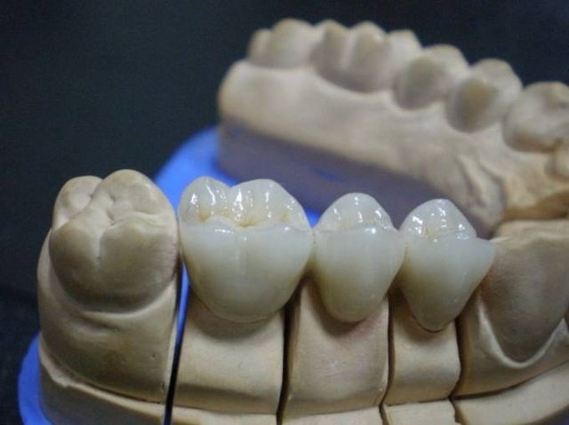 Trabalho tradicional dentário de restauração fixa do início ao fim em coroa e ponte de laboratório dentário