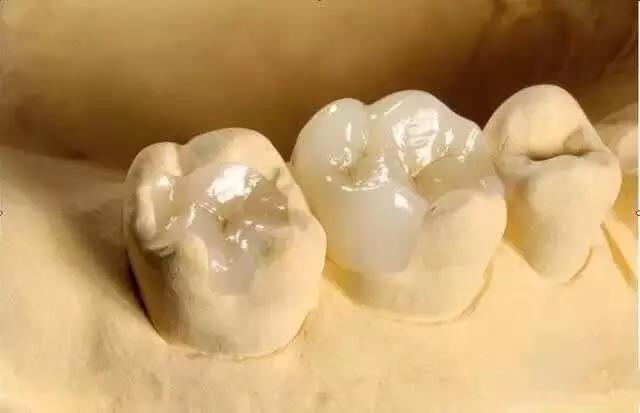 Inlay dental de zircônia para salvar pequenos defeitos superficiais do dente natural