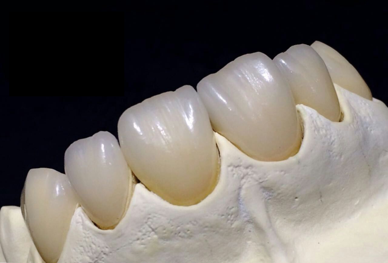 Precauções sobre dentes de porcelana de zircônia