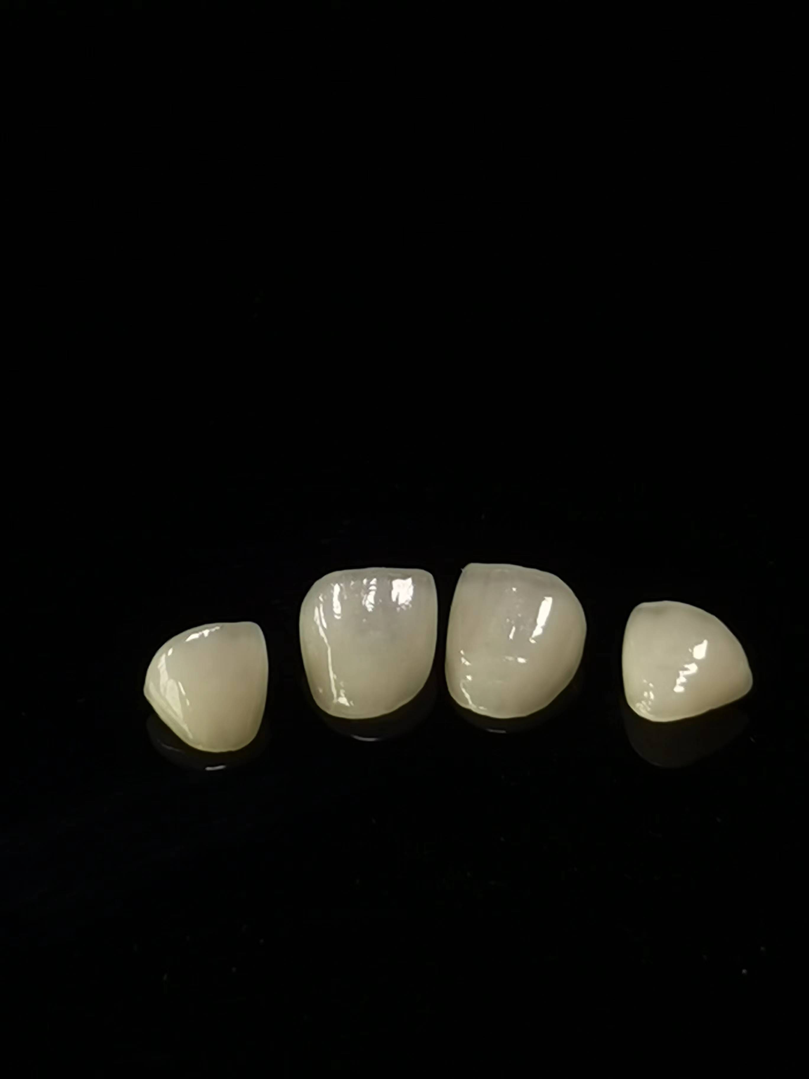 Trabalho de laboratório dentário E.max