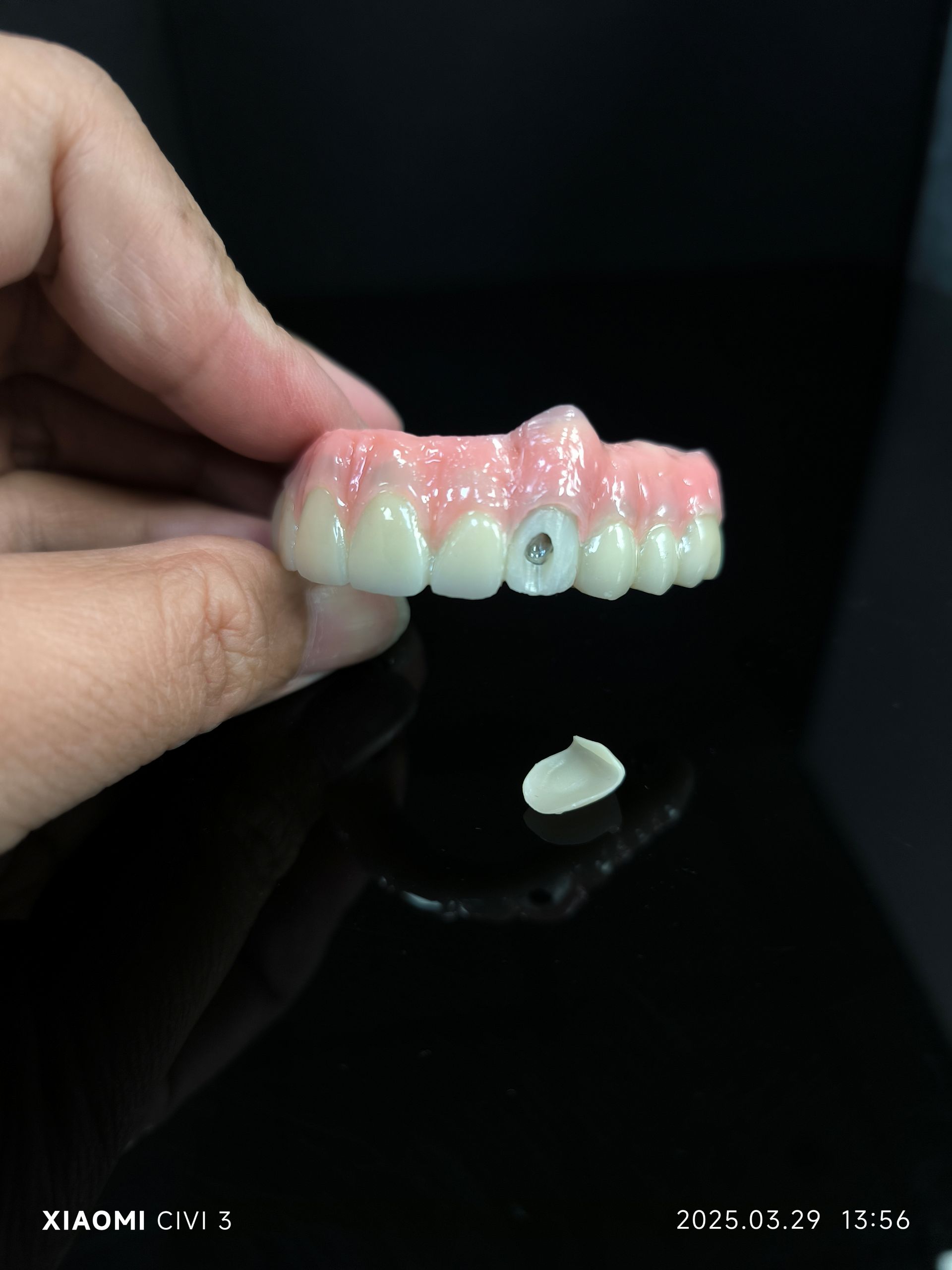 All On 4 - Solução de ponte de zircônia híbrida para orifício de parafuso vestibular