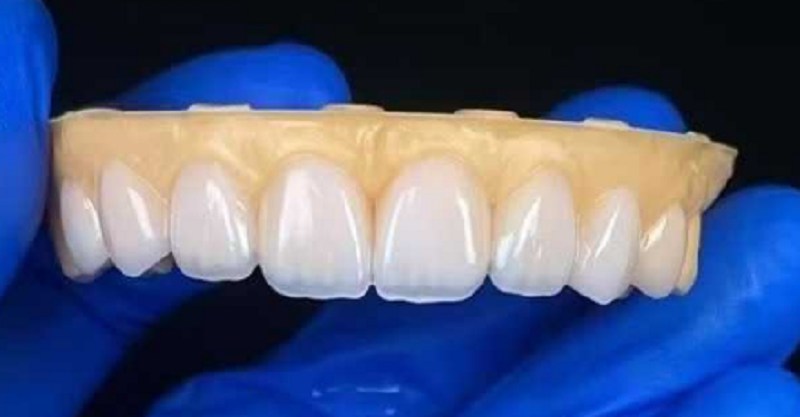 Facetas dentárias para reparar o problema de lacunas dentárias excessivas