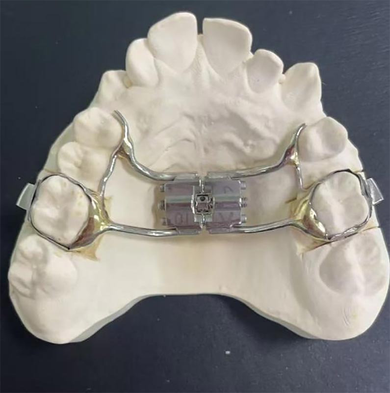 O que é um rápido expansor maxilar (RME)?