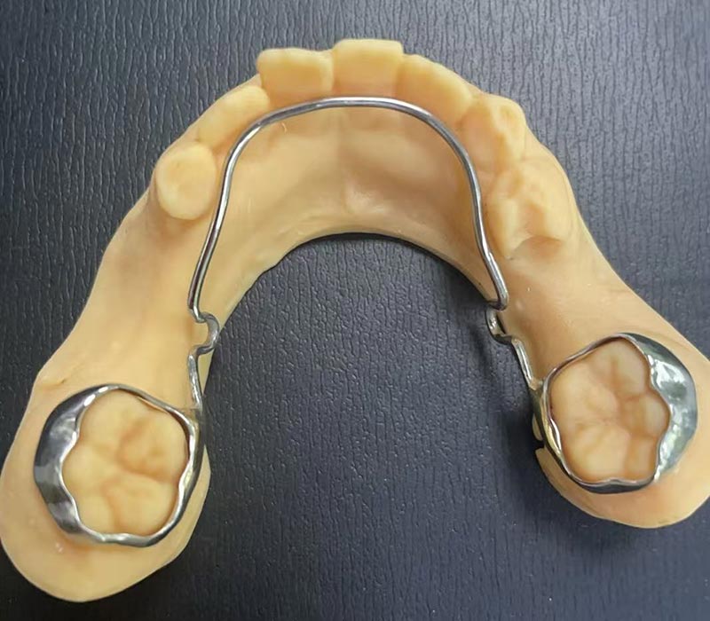 Retentor de Arco Lingual Mandibular