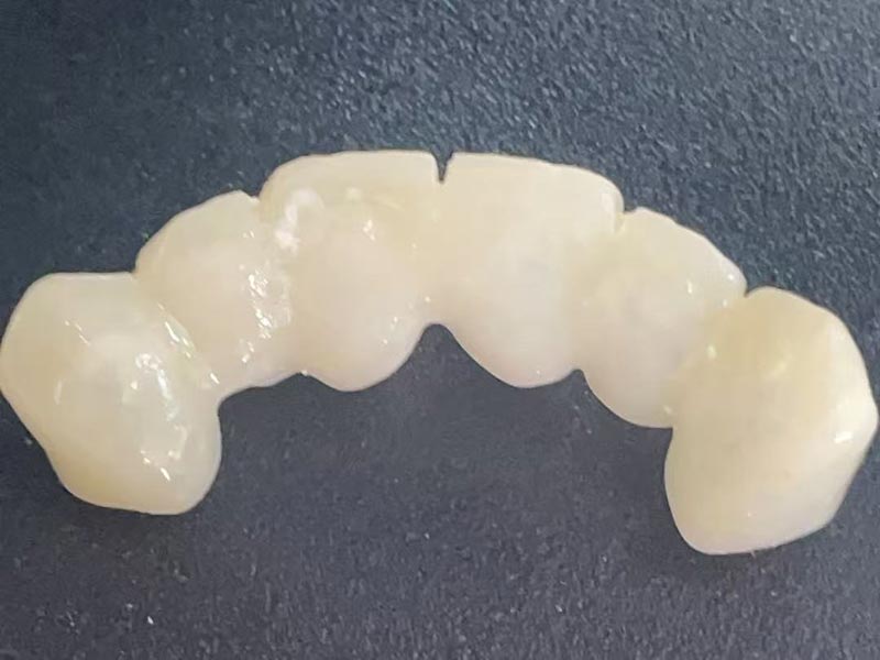 O que é uma “coroa temporária”? Por que você precisa de um?