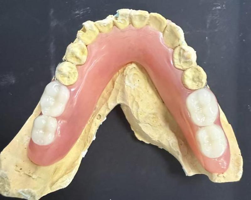 Por quanto tempo as próteses parciais devem ser usadas? Dicas para usar dentaduras para compartilhar com os mais velhos