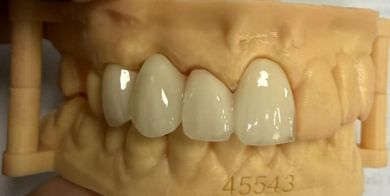 Por que as bordas da coroa dentária ficam pretas? E como consertar