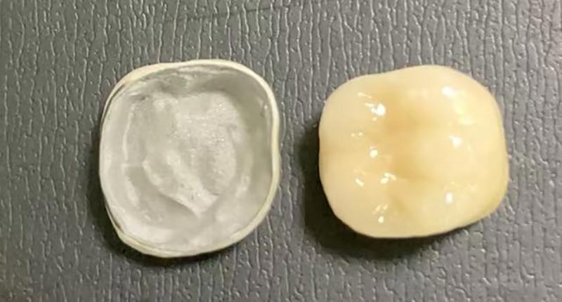 O que fazer quando sua coroa de porcelana lascar? Veja por que isso acontece e como consertar