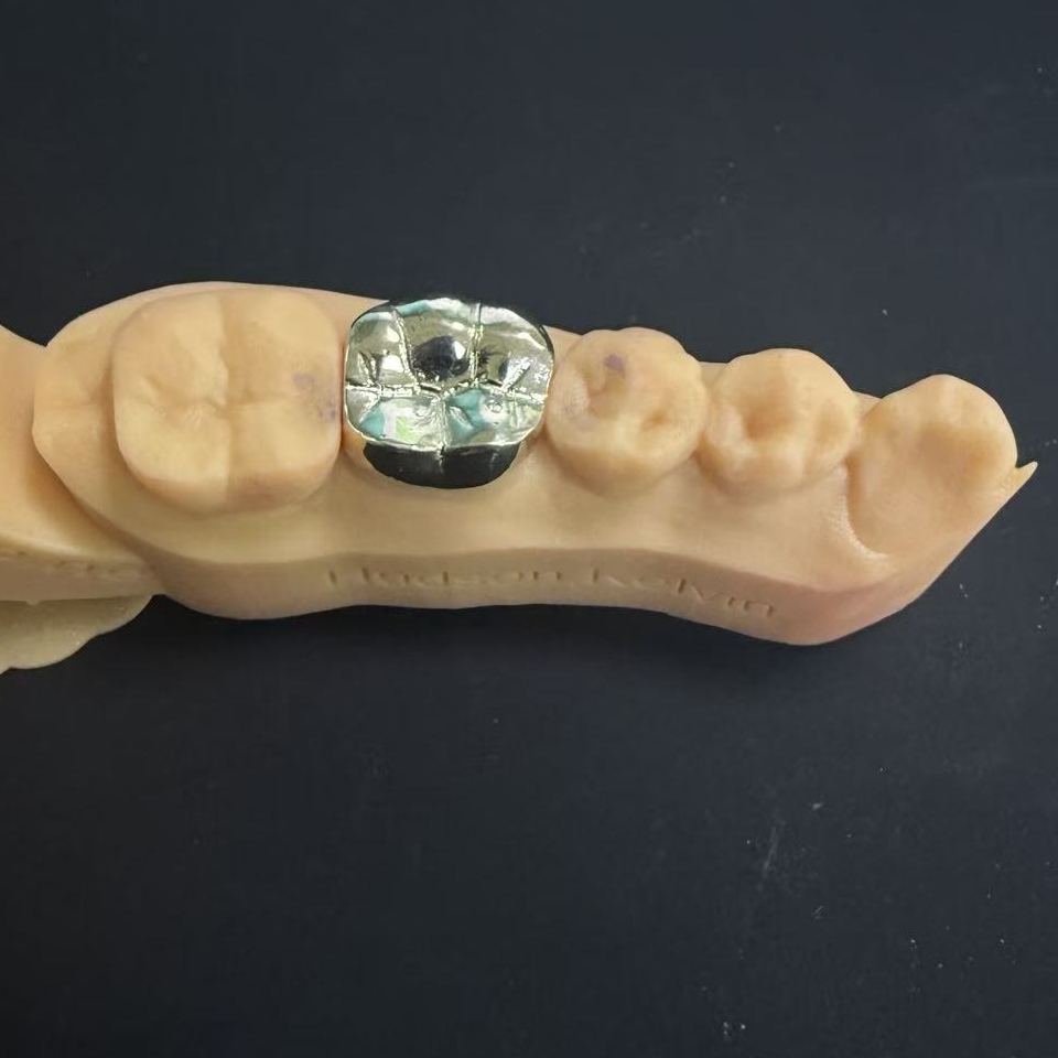 Coroas de ouro: a escolha de metais preciosos para restauração dentária vitalícia