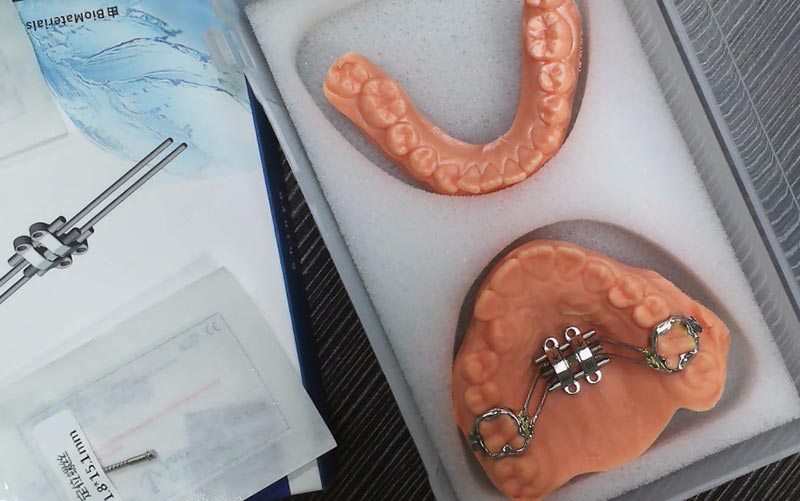 Entenda a expansão esquelética do MSE com o WM Dental Lab