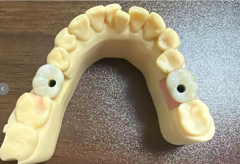 Por que a implantação do dente frontal é mais difícil do que a implantação do dente posterior?