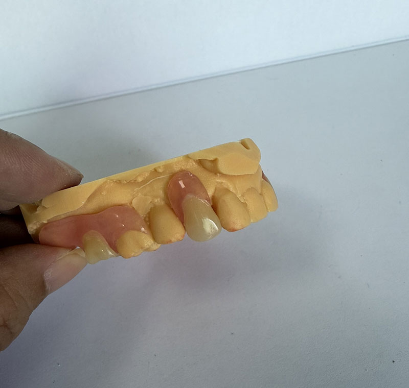 Parciais Valplast no WM Dental Lab