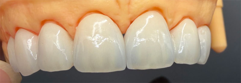 Impacto dos dentes não vitais nas coroas totalmente cerâmicas e nos tratamentos correspondentes