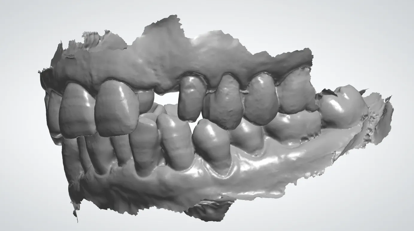 Restaure seu sorriso: soluções líderes para dentes perdidos