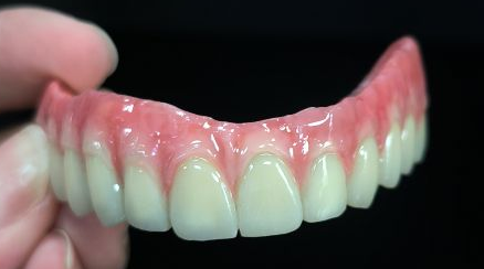 All On 4 Hybrid - Malo Bridge Full Zirconia Crowns Over Titanium Struction